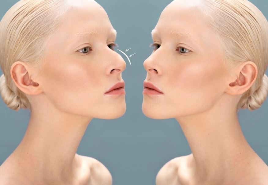 Double Jaw Surgery